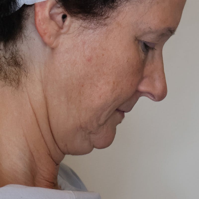 Facelift Before & After Gallery - Patient 232890 - Image 5