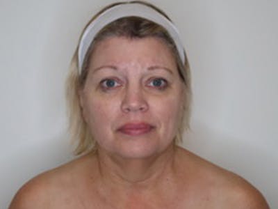 Facelift Before & After Gallery - Patient 403905 - Image 1