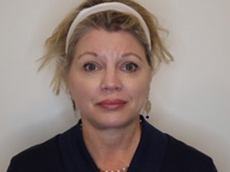 Facelift Before & After Gallery - Patient 403905 - Image 2