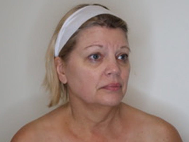 Necklift Before & After Gallery - Patient 363970 - Image 3