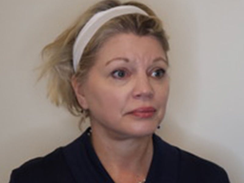 Facelift Before & After Gallery - Patient 403905 - Image 4