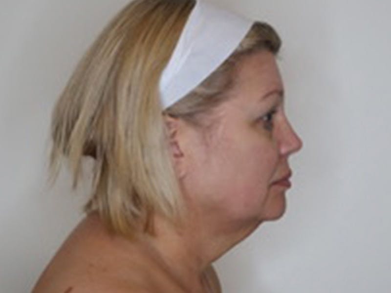 Facelift Before & After Gallery - Patient 403905 - Image 5
