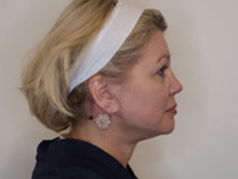 Necklift Before & After Gallery - Patient 363970 - Image 6