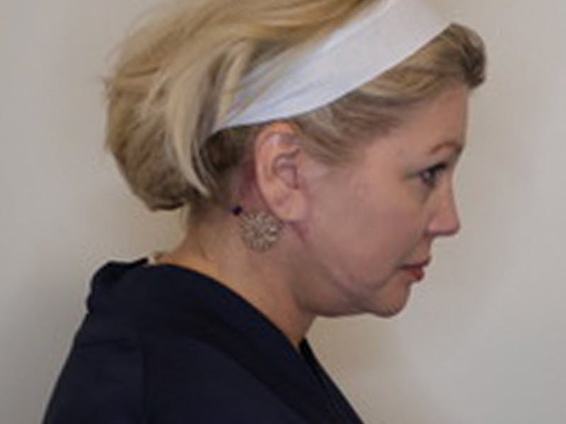 Facelift Before & After Gallery - Patient 403905 - Image 8