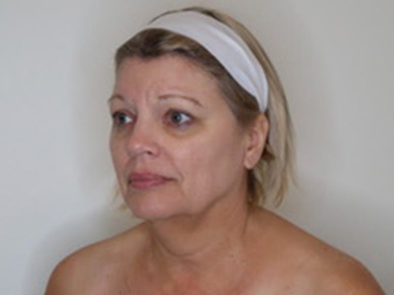 Facelift Before & After Gallery - Patient 403905 - Image 9