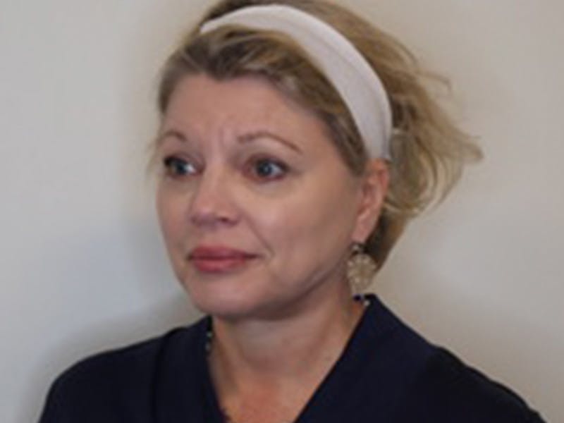 Facelift Before & After Gallery - Patient 403905 - Image 10