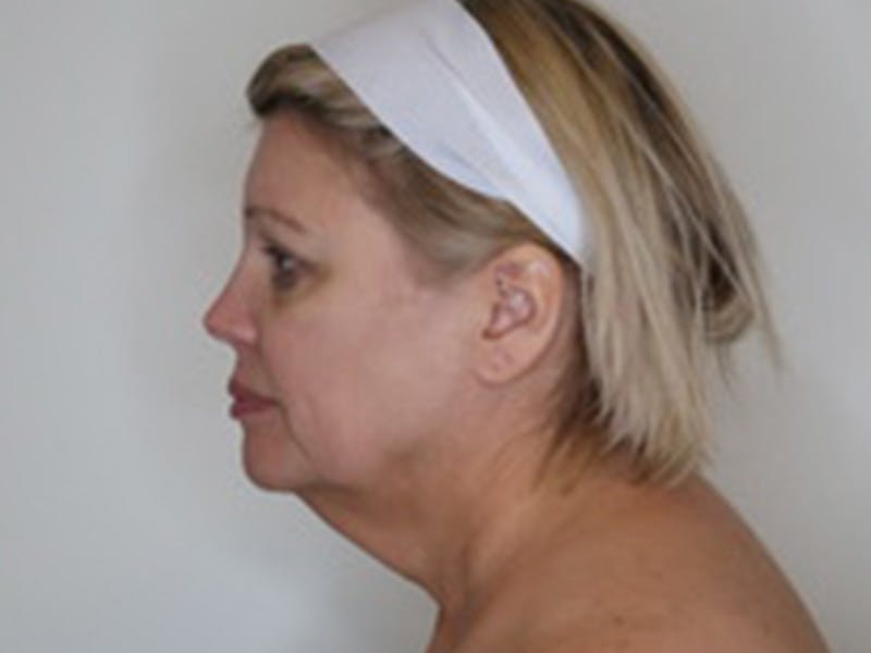 Necklift Before & After Gallery - Patient 363970 - Image 11