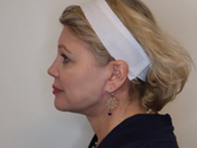 Facelift Before & After Gallery - Patient 403905 - Image 12