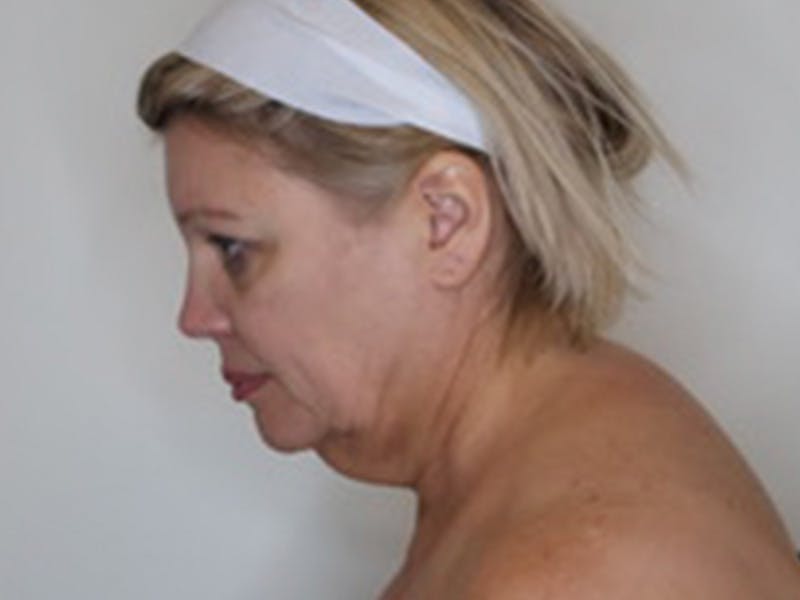 Necklift Before & After Gallery - Patient 363970 - Image 13