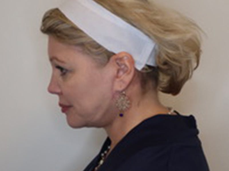 Facelift Before & After Gallery - Patient 403905 - Image 14