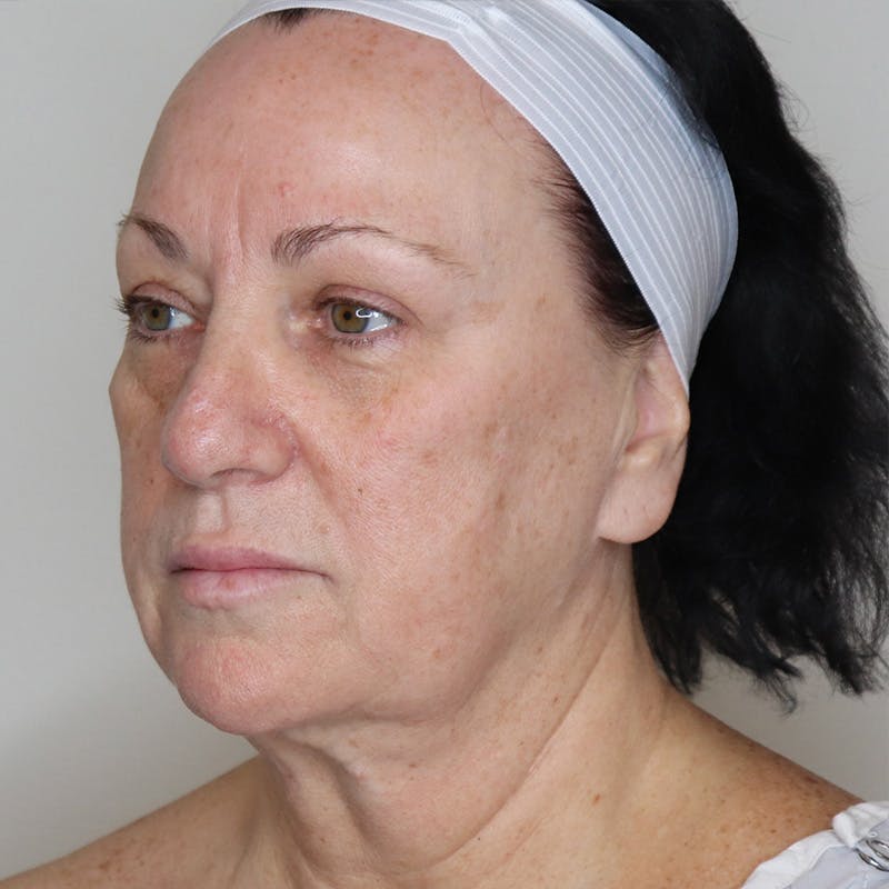 Facelift Before & After Gallery - Patient 163094 - Image 1