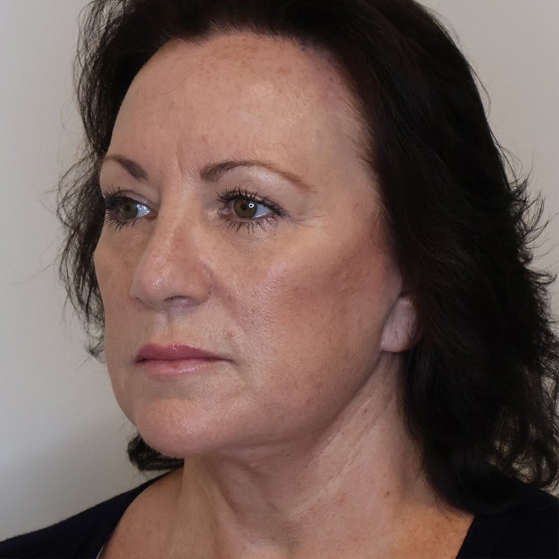 Facelift Before & After Gallery - Patient 163094 - Image 2