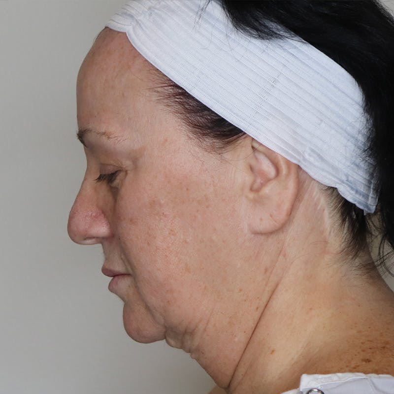 Necklift Before & After Gallery - Patient 141324 - Image 3