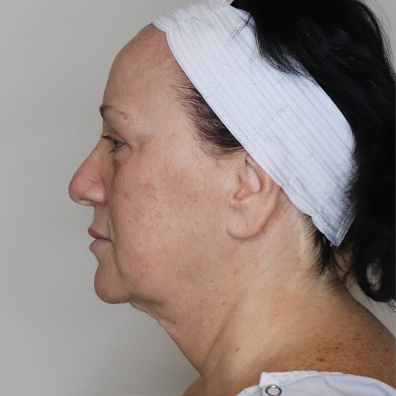Necklift Before & After Gallery - Patient 141324 - Image 5