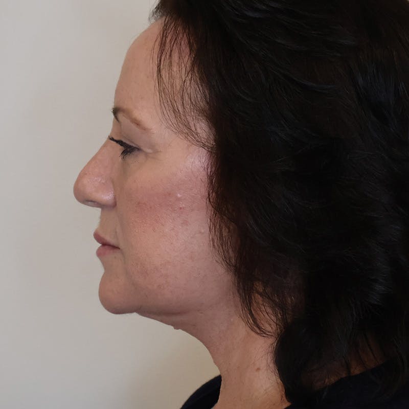 Facelift Before & After Gallery - Patient 163094 - Image 6