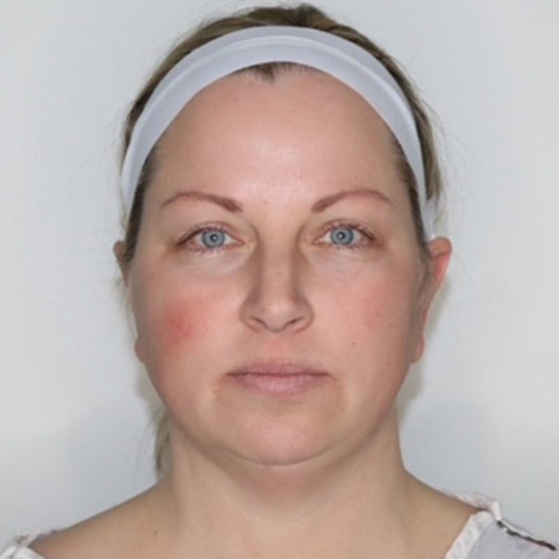 Necklift Before & After Gallery - Patient 340014 - Image 3