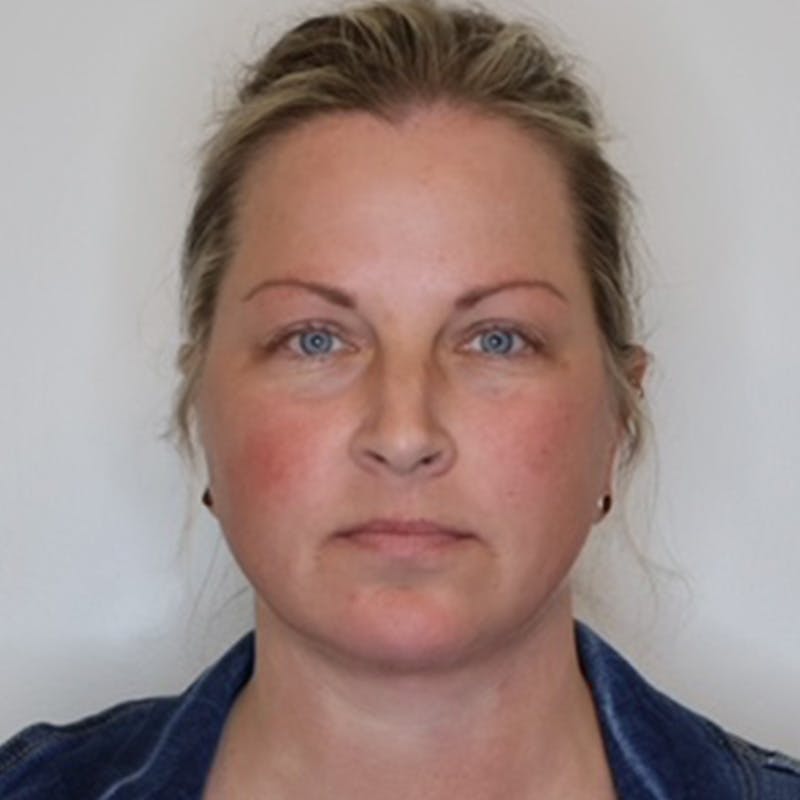 Facelift Before & After Gallery - Patient 297746 - Image 2