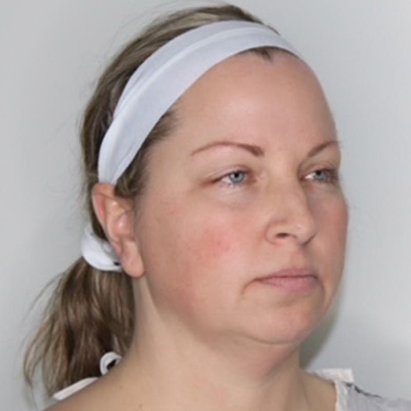 Necklift Before & After Gallery - Patient 340014 - Image 1