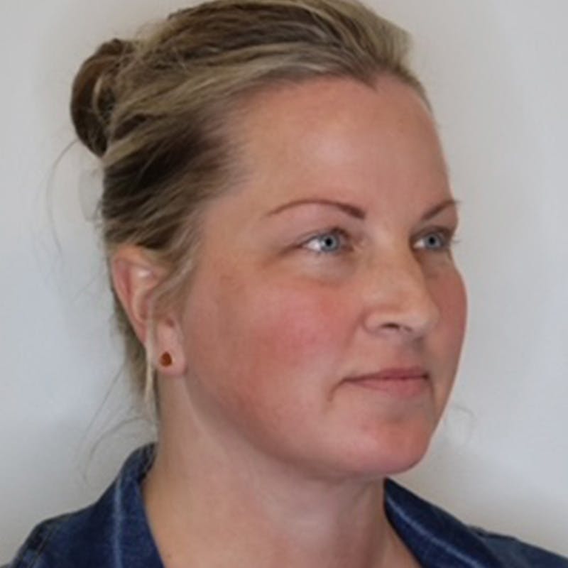 Facelift Before & After Gallery - Patient 297746 - Image 4