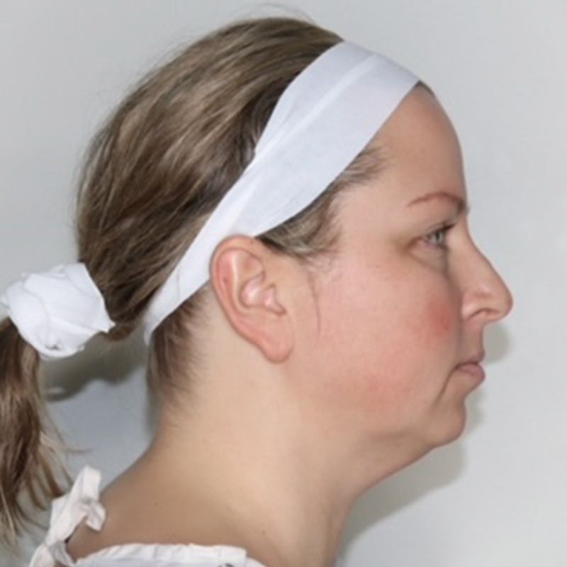 Facelift Before & After Gallery - Patient 297746 - Image 5