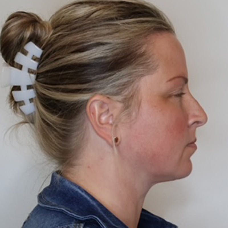 Necklift Before & After Gallery - Patient 340014 - Image 6
