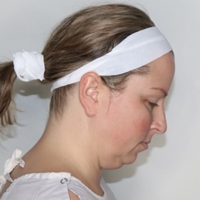 Necklift Before & After Gallery - Patient 340014 - Image 7