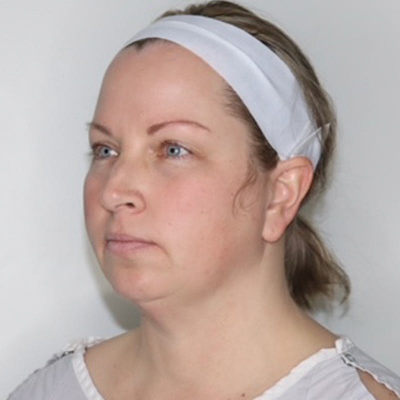 Necklift Before & After Gallery - Patient 340014 - Image 9