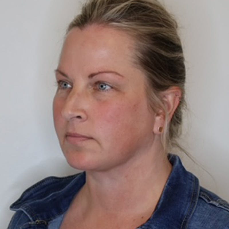 Facelift Before & After Gallery - Patient 297746 - Image 10