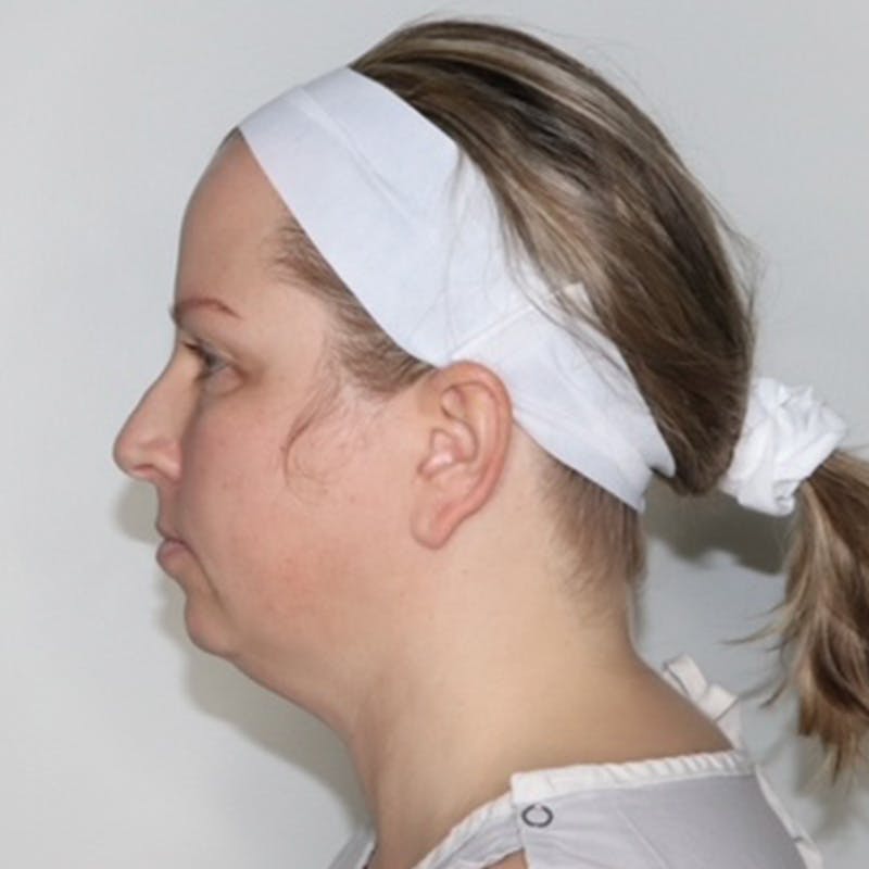 Necklift Before & After Gallery - Patient 340014 - Image 11
