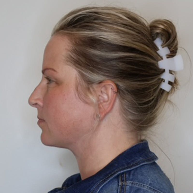 Facelift Before & After Gallery - Patient 297746 - Image 12