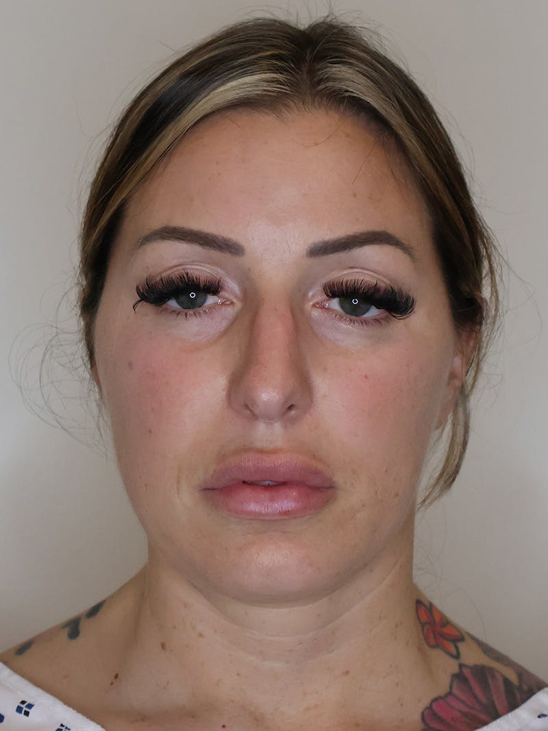 Rhinoplasty/Nose Reshaping Before & After Gallery - Patient 201657 - Image 5