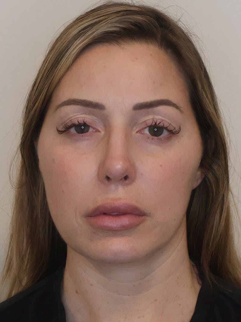 Rhinoplasty/Nose Reshaping Before & After Gallery - Patient 201657 - Image 6