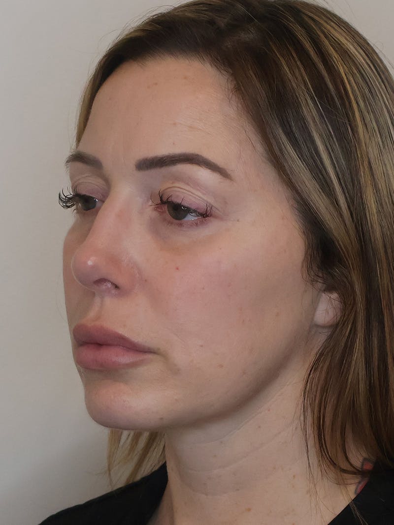 Rhinoplasty/Nose Reshaping Before & After Gallery - Patient 201657 - Image 4