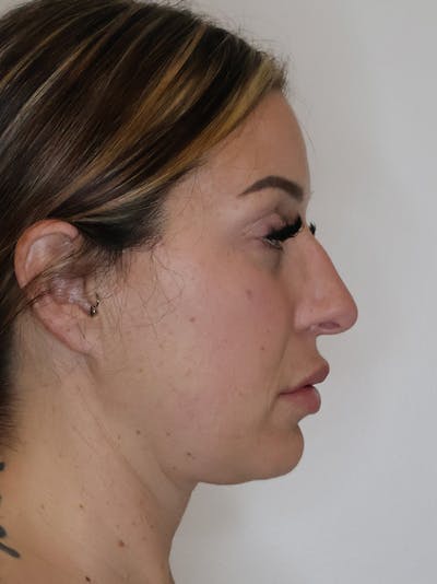 Rhinoplasty/Nose Reshaping Before & After Gallery - Patient 201657 - Image 1