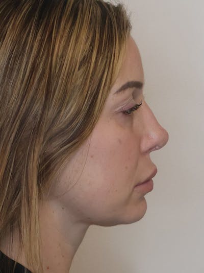 Rhinoplasty/Nose Reshaping Before & After Gallery - Patient 201657 - Image 2