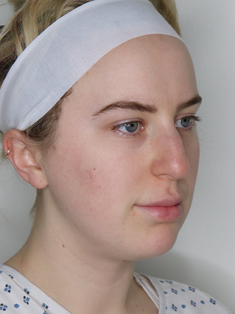 Rhinoplasty/Nose Reshaping Before & After Gallery - Patient 335799 - Image 5