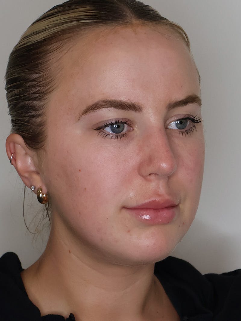 Rhinoplasty/Nose Reshaping Before & After Gallery - Patient 335799 - Image 6