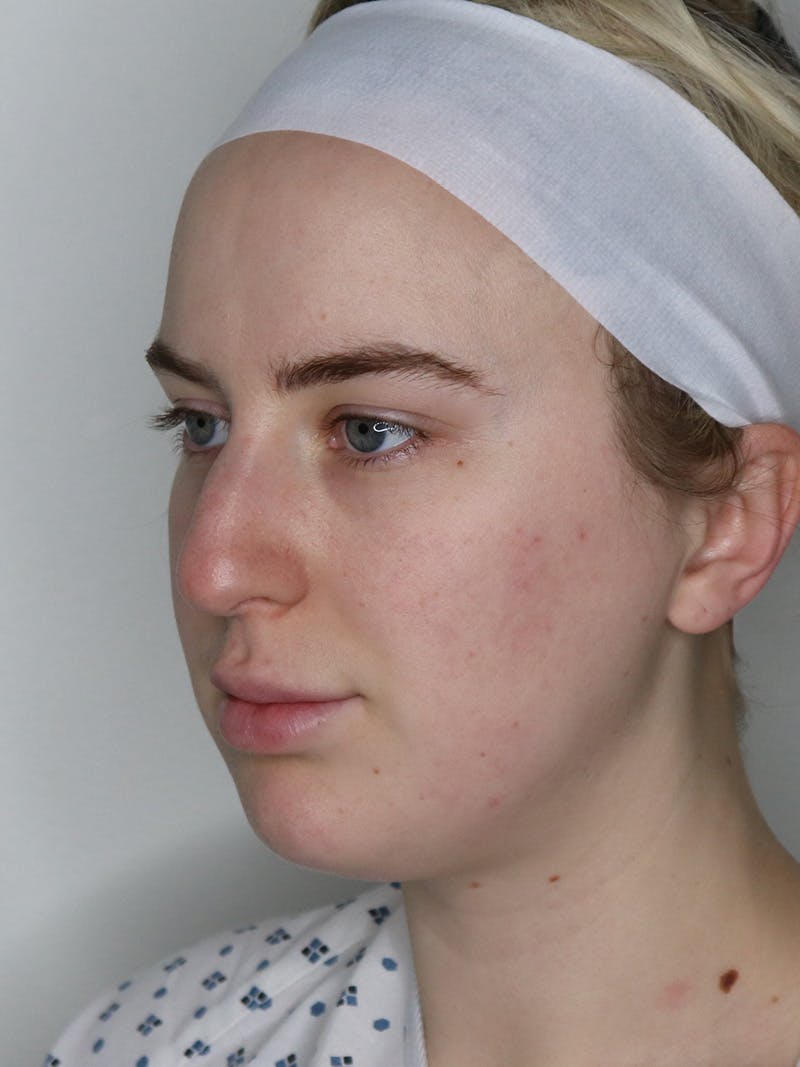 Rhinoplasty/Nose Reshaping Before & After Gallery - Patient 335799 - Image 3
