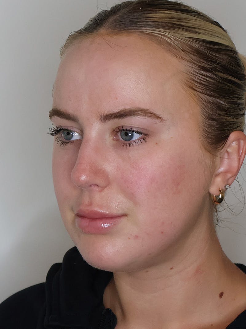Rhinoplasty/Nose Reshaping Before & After Gallery - Patient 335799 - Image 4