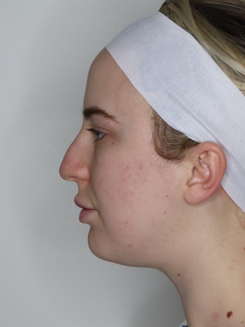 Rhinoplasty/Nose Reshaping Before & After Gallery - Patient 335799 - Image 1