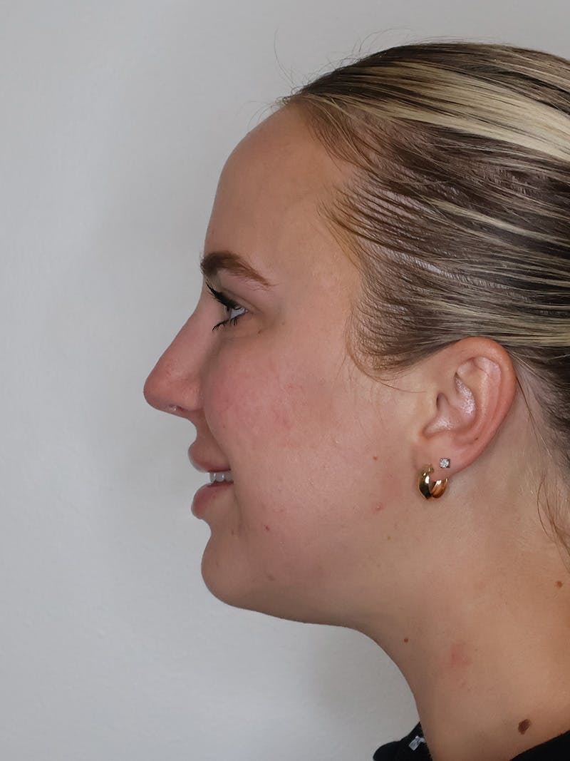 Rhinoplasty/Nose Reshaping Before & After Gallery - Patient 335799 - Image 2