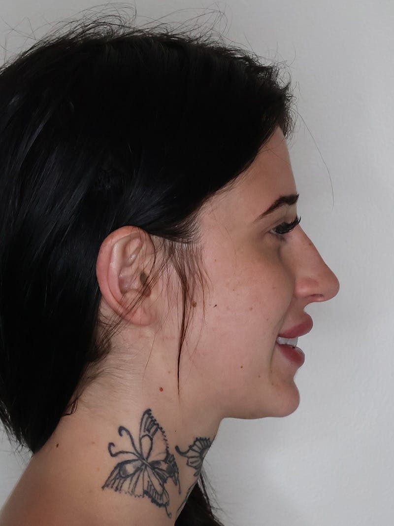 Rhinoplasty/Nose Reshaping Before & After Gallery - Patient 697367 - Image 1