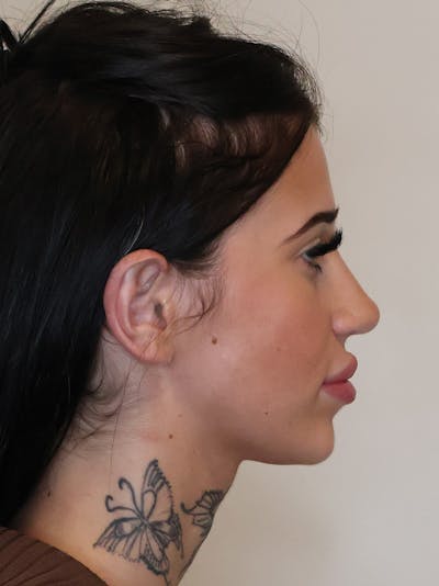 Rhinoplasty/Nose Reshaping Before & After Gallery - Patient 697367 - Image 2
