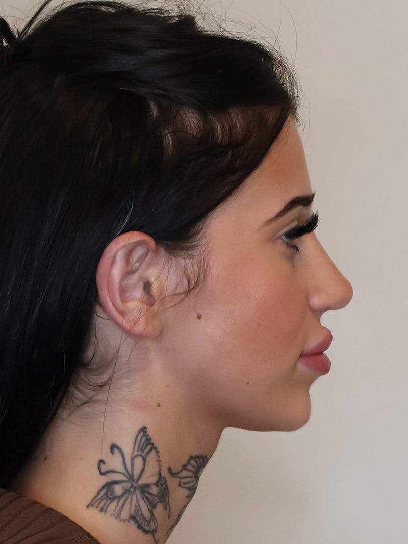 Rhinoplasty/Nose Reshaping Before & After Gallery - Patient 697367 - Image 2