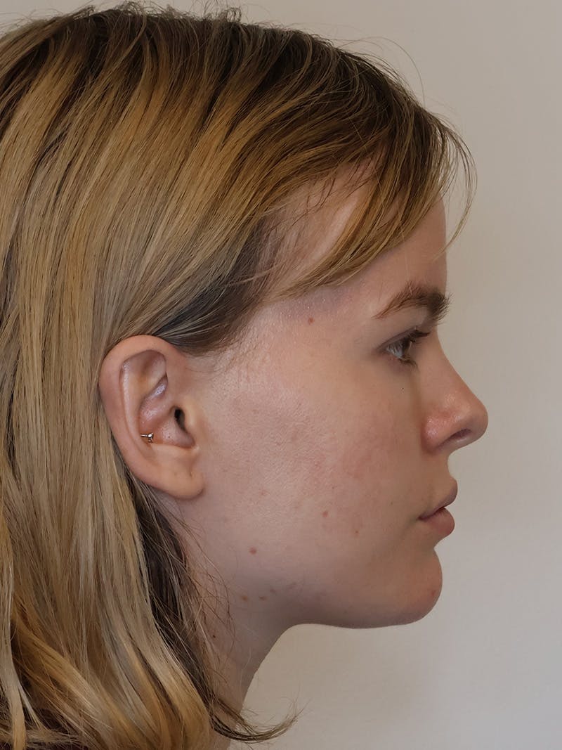 Rhinoplasty/Nose Reshaping Before & After Gallery - Patient 202474 - Image 1
