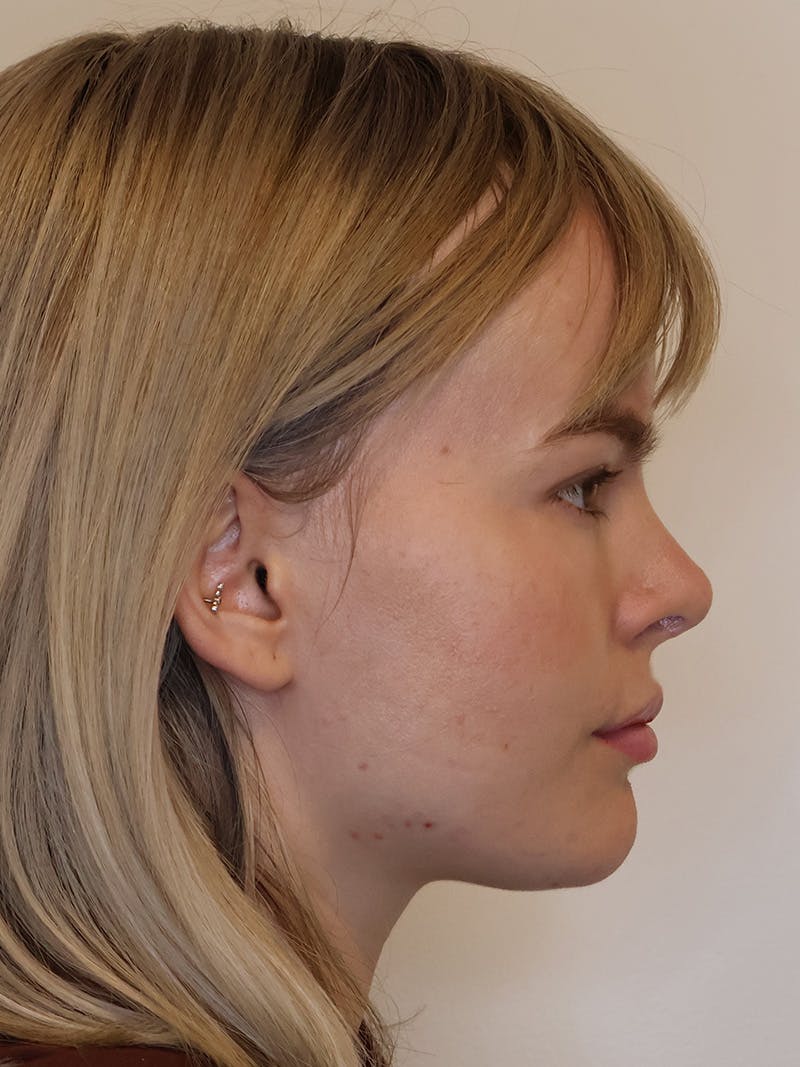 Rhinoplasty/Nose Reshaping Before & After Gallery - Patient 202474 - Image 2