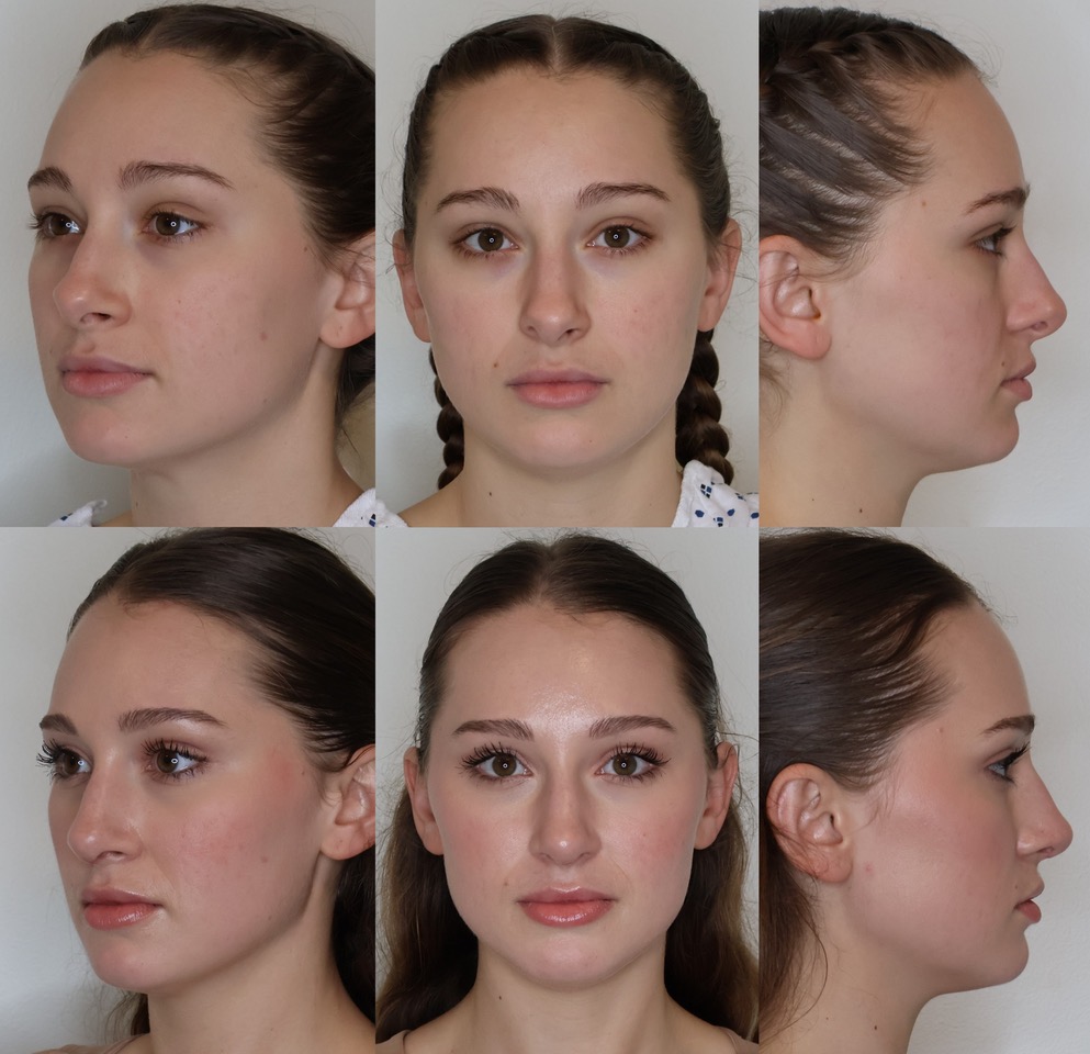 Before and afters of a rhinoplasty in Portland, Maine