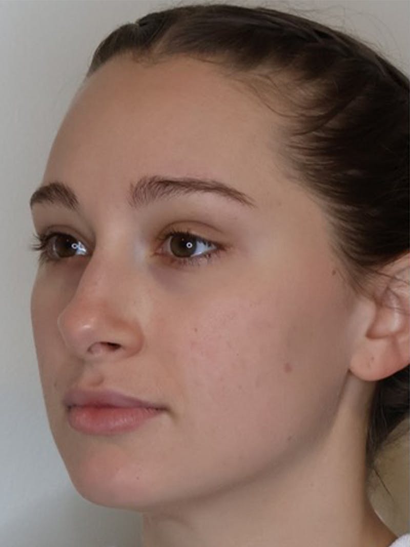 Rhinoplasty/Nose Reshaping Before & After Gallery - Patient 331514 - Image 3