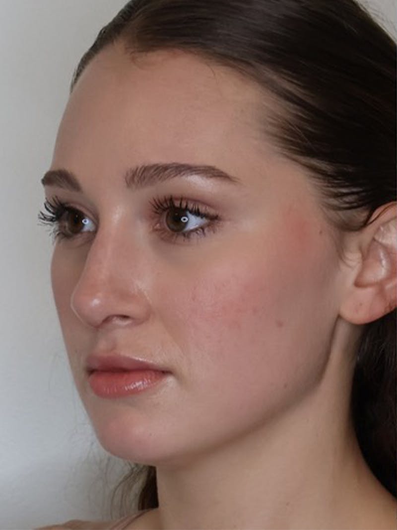 Rhinoplasty/Nose Reshaping Before & After Gallery - Patient 331514 - Image 4