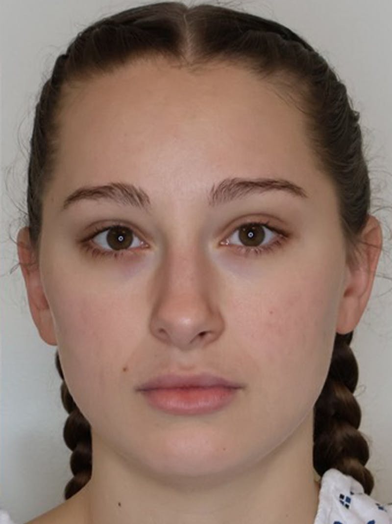 Rhinoplasty/Nose Reshaping Before & After Gallery - Patient 331514 - Image 5